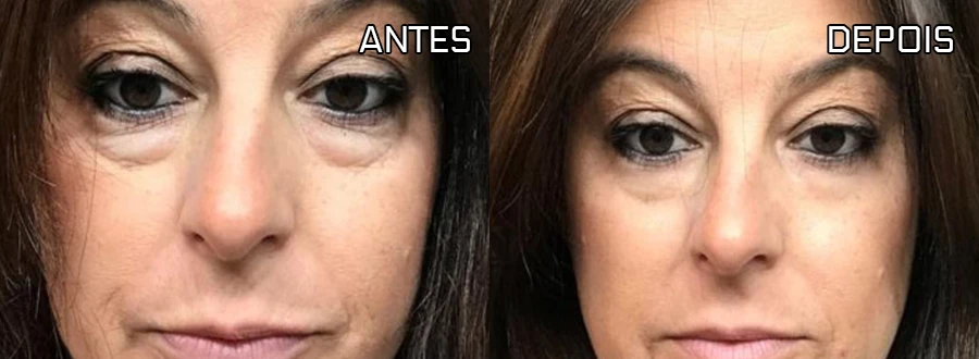 Antes e depois do caso 1