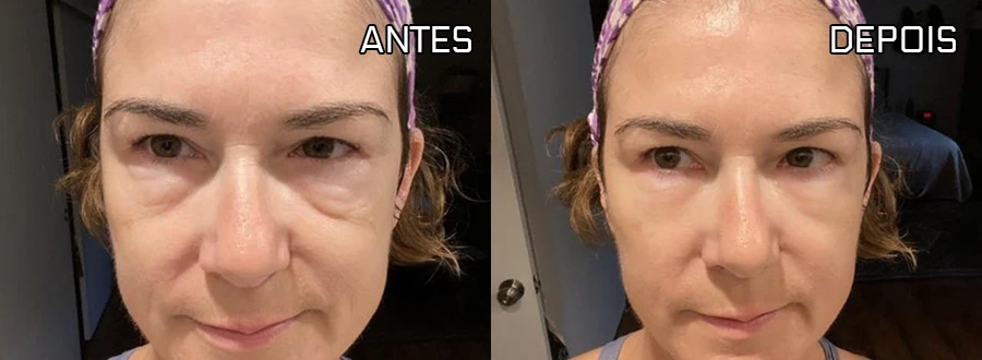 Antes e depois do caso 2