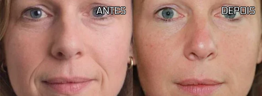Antes e depois do caso 4